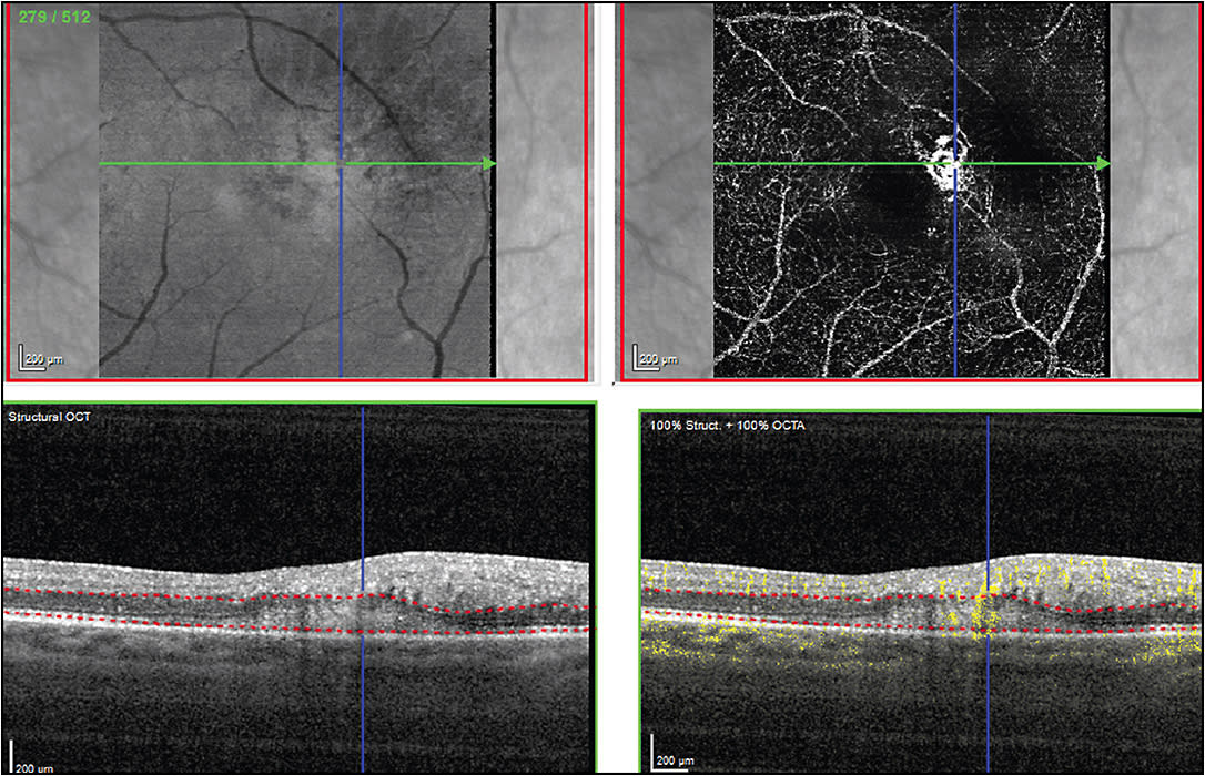 Figure 1. OCTA demonstrating a type 2 CNVM above the RPE. The OCT B scan in the lower right-hand corner shows proper segmentation of the CNVM between the dotted red lines. The yellow signal within the CNVM identifies flow, which is then processed into the image in the upper right-hand corner showing the neovascularization within the membrane.