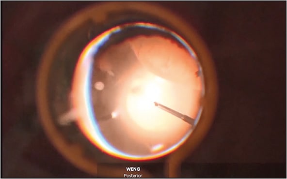 Figure 2. Intraoperative photo, which shows the inferonasal retinal detachment that was discovered while performing 25-gauge pars plana vitrectomy through an Eckhardt temporary keratoprosthesis.