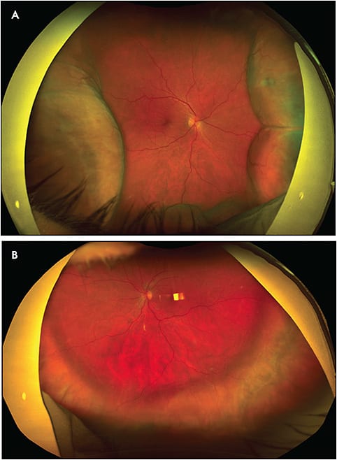 Figure 2. Widefield color photos (Optos) of the right (A) and left (B) eyes demonstrating 360-degree choroidal detachments.