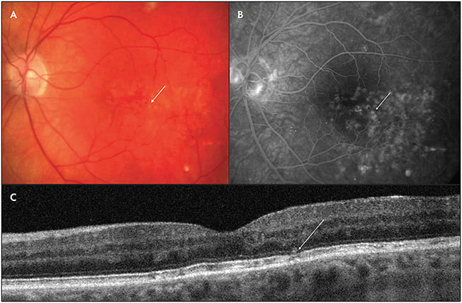 Figure 1. Fundus color (A), fluorescein angiography (B), and optical coherence tomography scan (C) of left eye 6 months following modified ETDRS sectoral grid laser application for diabetic macular edema. Focal, outer retinal pigmentary disturbances (arrows) are noted on all 3 imaging modalities.
