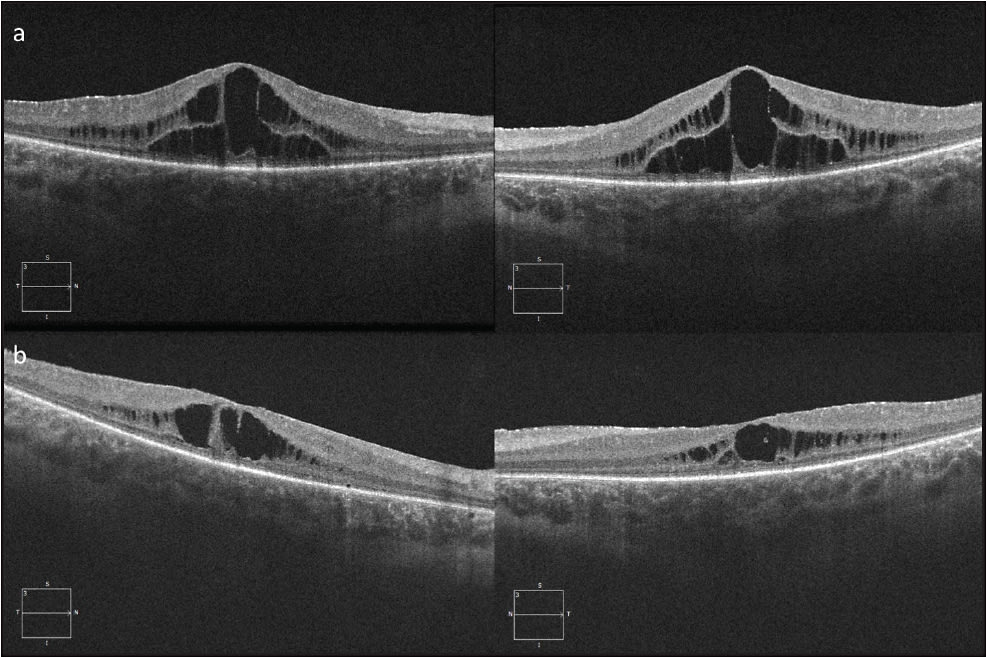 Figure 4. Spectral-domain OCT of a 16-year-old boy with retinitis pigmentosa with bilateral CME. Visual acuity was 20/100 in the right eye and 20/80 in the left eye (A). He was started on topical dorzolamide, and 1 year later, there was improvement in central macular thickness in both eyes (B). Visual acuity was 20/150 in the right eye and 20/80 in the left eye. 
COURTESY OF MINA M. CHUNG, MD.