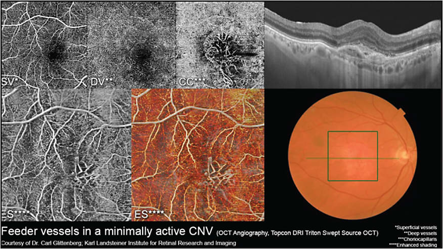 Figure 8. SS-OCT combined with OCT angiography of feeder vessels in a minimally active choroidal neovascular membrane. 
IMAGE COURTESY TOPCON.