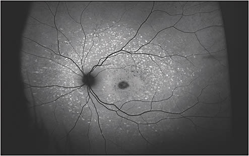 Figure 3. Fundus autofluorescence image in a patient with Stargardt dystrophy, demonstrating the highly autofluorescent lipofuscin-containing flecks, with a ring of peripapillary sparing of normal autofluorescence. Although this finding of peripapillary sparing is not pathognomic for ABCA4-mediated degeneration, it is highly suggestive of a hereditary etiology of disease.
