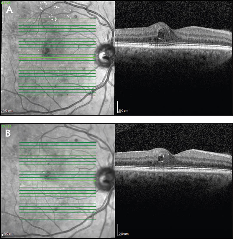 Figure 1. A 53-year-old male with type 2 diabetes mellitus presented for scheduled follow-up. He had no visual complaints. Best-corrected visual acuity (BCVA) was 20/20 OD. Spectral-domain optical coherence tomography (SD-OCT) OD revealed center-involved DME. Central subfield thickness (CST) was 362 µm. The patient was advised to tighten his control of blood sugar, lipids, and blood pressure (A). The patient returned for follow-up 3 months later. He remained asymptomatic, and BCVA was 20/15 OD. SD-OCT OD revealed improved macular edema. CST improved to 340 µm (B).