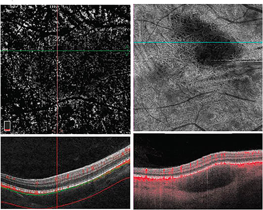 Figure 3. A 47-year-old male with presumed sarcoidosis based on CT chest findings. SD OCTA (Optovue Avanti RTVue-XR) is unable to capture a large subfoveal granuloma that is readily seen on SS OCTA.