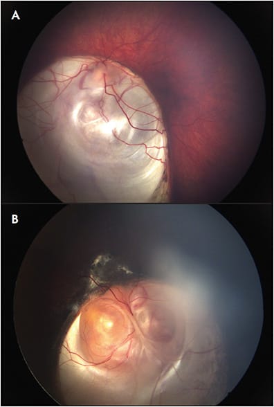 Figure 4. Left eye of a child with fovea-sparing chorioretinal coloboma (A). Right eye of a patient with chorioretinal coloboma with a treated choroidal neovascular membrane in the foveal area (B).