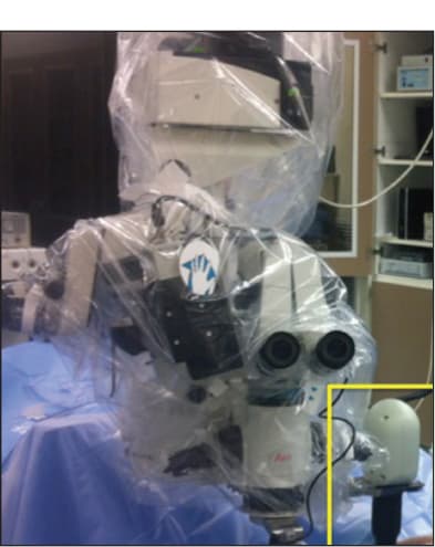 Figure 1. Microscope-mounted SD-OCT system (yellow box), which allows for use with a draped or undraped microscope. The entire probe can be draped with the microscope or left undraped (as pictured). Mounting the probe to the microscope allows for rapid and reproducible imaging while minimizing surgical delay.
