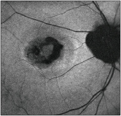 Figure 4. Geographic atrophy. Decreased AF in areas of atrophy of the retinal pigment epithelium (RPE) and RPE/photoreceptor outer segment complex.