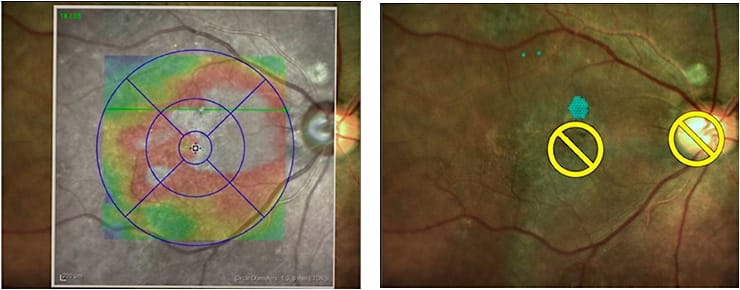Figure 5. The treatment plan for this patient with chronic serous chorioretinopathy included microsecond pulsing laser with a confluent grid of 100 μm, 100 ms spots, and spacing 0.
