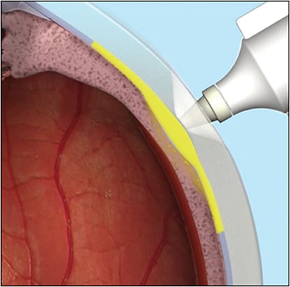 Figure 4. Suprachoroidal injection using a 1-mm, 30-gauge microinjector syringe developed by Clearside Biomedical. 
COURTESY OF CLEARSIDE BIOMEDICAL.