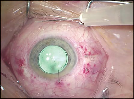 Figure 5. Intravitreal triamcinolone acetonide can aid in suppressing postoperative inflammation in complex surgical cases.