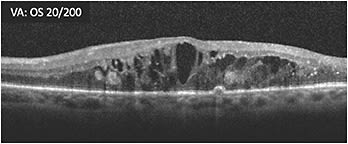 A: Two-month status post vitrectomy for nonclearing vitreous hemorrhage in PDR