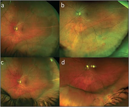 Figure 1. A 32-year-old female presented with macula-on inferotemporal retinal detachment in the left eye with lattice and holes superiorly and multiple larger holes inferiorly associated with the detachment (A, B). She underwent successful placement of a 41 band with a 516 grooved element and cryotherapy, which provided circumferential support to include superior pathology (C) as well as broader support to the inferior pathology spanning a larger anteroposterior distribution (D). Preoperative and postoperative central acuities were both 20/20 in this eye.