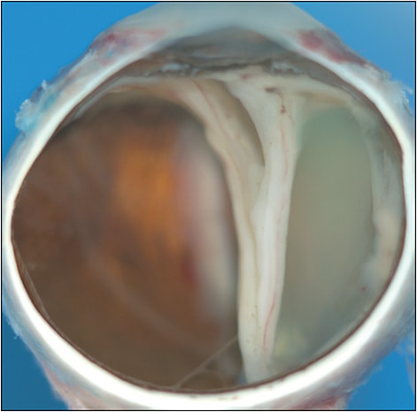 Figure 3. Gross pathology image of an eye enucleated for intractable pain following acute post-intravitreal injection Streptococcus mitus endophthalmitis. The image shows a funnel-shaped retinal detachment.