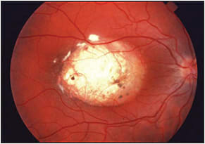 Figure 3. Grade 3 North Carolina macular dystrophy in a 23-year-old male with 20/50 visual acuity. Note the sharp shelving temporal edge fibrosis. Finding this lesion in a family member significantly helps to confirm the diagnosis.