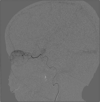 Figure 1. Digitally subtracted selective arteriogram image of the ophthalmic artery without balloon occlusion prior to intra-arterial chemotherapy infusion.