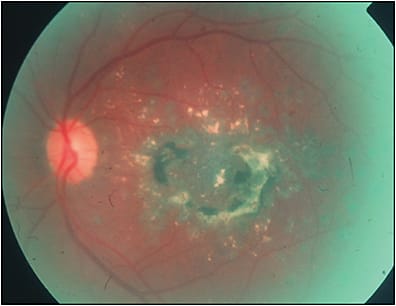Figure 3. The color fundus photo demonstrates a large subfoveal choroidal neovascularization as a complication from laser photocoagulation that broke through Bruch’s membrane.