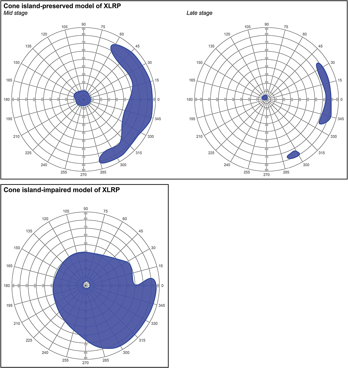 Figure 1. Cone island-preserved and cone island-impaired models of X-linked retinitis pigmentosa (XLRP). In all of the panels, blue indicates areas of normal or near normal rod and cone photoreceptor function. The top image depicts retina maps showing areas of remaining photoreceptor function in the mid and late stages of XLRP with the cone-island preserved phenotype. In the early stage (not shown), rod and cone photoreceptor function is normal or near normal in the central and paracentral regions and throughout most of the periphery. In the midstage, photoreceptor loss in the midperiphery separates normal or near normal photoreceptor function in the central island from that in the periphery. In the late stage, photoreceptor loss expands into both the paracentral and central regions and also into the periphery, until there is little to no rod or cone photoreceptor function remaining. The bottom image is a retina map showing a representative case of XLRP with the cone island-impaired phenotype. In this model, cone photoreceptors tend to be more sensitive to impairment than rod photoreceptors. Loss of photoreceptor function is often restricted to the central and paracentral regions with normal or near normal photoreceptor function in the periphery. The cone island-preserved and cone island-impaired models are based on longitudinal data from an observational study of patients with XLRP.8