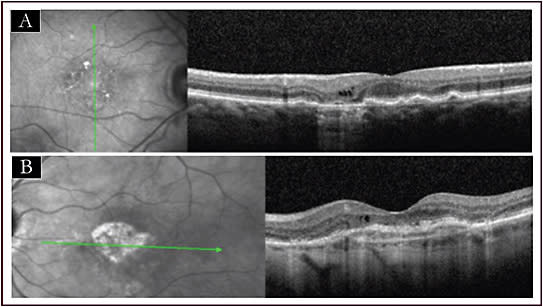Figure 5. Optical coherence tomography images from eyes with well-controlled neovascular age-related macular degeneration with cysts over atrophy (A) and cysts over fibrosis (B). Such small cystic spaces may be confused with edema from choroidal neovascularization–related active exudation.
Images courtesy of Carl D. Regillo, MD, FACS
