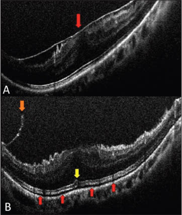Figure 2. Intraoperative OCT scans during epiretinal membrane surgery. Preincision scan (A) reveals prominent ERM (red arrow) with inner retinal distortion. Postpeel scan (B) reveals residual membrane (orange arrow) and expansion of the IS/OS and cone outer segment tips to the RPE distance (red arrows). The outer retinal architectural changes are most prominent in the subfoveal area (yellow arrow).