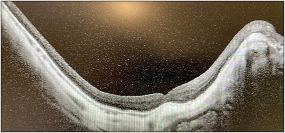 Figure 2. Optical coherence tomography imaging through a C3F8 gas-filled eye 1 week after pars plana vitrectomy with membrane peeling shows that the macular hole has closed.