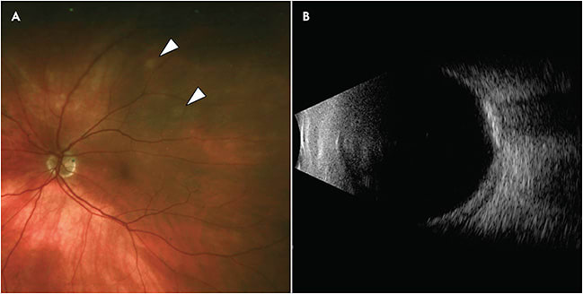 Figure 3. A 79-year-old male was referred for multifocal amelanotic fundus lesions. Fundus photograph of the left eye shows deep yellow-to-white lesions (arrows) along the superotemporal arcade (A). B-scan ultrasonography reveals highly reflective lesions with posterior shadowing, confirming the presence of calcium (B).