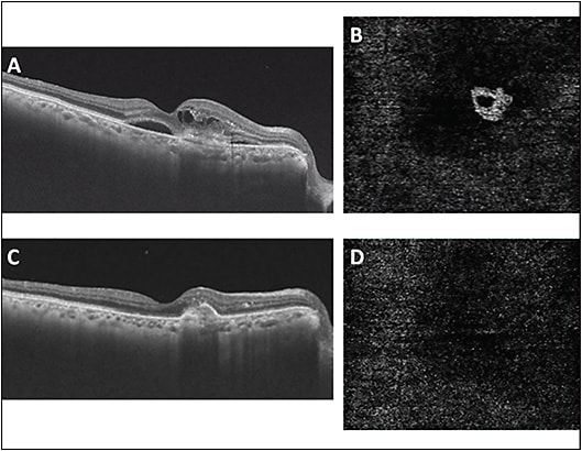 Figure 2. Optical coherence tomography (OCT) showing presence of intraretinal cystoid spaces, subretinal fluid and hyper-reflectivity in subretinal space with a breach in retinal pigment epithelium (RPE) (A). OCT angiography (OCTA) imaging (Triton; Topcon) shows the neovascular complex in outer retinal slab just above RPE (B). The diagnosis of retinal angiomatous proliferation was made. Post one intravitreal ziv-aflibercept injection, OCT shows absence of intra- and subretinal fluid with fibrovascular pigment epithelial detachment (C). OCTA shows nearly a complete disappearance of neovascular complex (D).