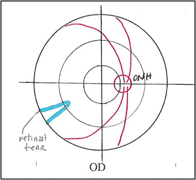 Figure 1. Peripheral retinal tear, 92201.