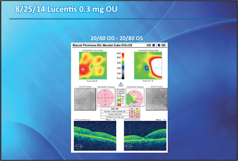 FIGURE 2. At this visit, visual acuity was stable and some improvement was shown on OCT. Ranibizumab was administered in both eyes.