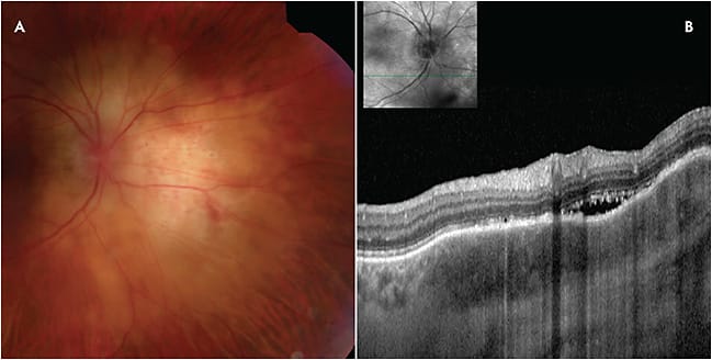 Figure 5. A 70-year-old female was referred for evaluation of an asymptomatic lesion that was noted incidentally on routine examination. The right fundus showed a circumpapillary amelanotic choroidal mass (A). Optical coherence tomography revealed choroidal thickening, overlying RPE irregularities, and mild subretinal fluid (B). Laboratory studies for tuberculosis and sarcoidosis (QuantiFERON-TB Gold, angiotensin-converting enzyme, lysozyme) were unremarkable. Positron emission tomography scan showed no abnormalities; however, standard chest computed tomography scan revealed hilar adenopathy, which was biopsied and confirmed noncaseating granulomas consistent with sarcoidosis.