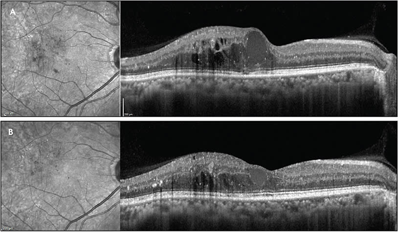 Figure 2. Optical coherence tomography images of a right eye of a patient with chronic diabetic macular edema before (A) and after (B) low-intensity photo stimulation (Micropulse; Iridex) grid application. There was no evidence of outer retinal structural changes seen 4 months following the procedure.
