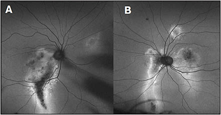Figure 2. The same patient showed in Figure 1 with chronic CSCR underwent fundus autofluorescence testing. FAF of the right eye (A) and left eye (B), respectively, demonstrates characteristic hypo- and hyperautofluorescent “guttering” characteristic of  multifocal chronic CSCR.