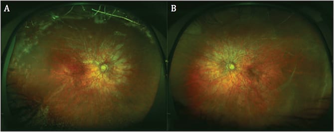 Figure 3. Fundus images of a pediatric patient with Stickler syndrome. The right eye (A) is 3 months status post pars plana vitrectomy, endolaser, and use of silicone oil tamponade for repair of a giant retinal tear with retinal detachment. The retina remains attached in the contralateral left eye (B).