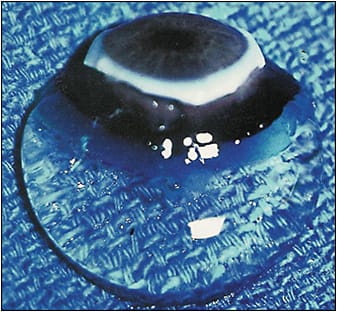 Figure 1. Intact whole vitreous body attached to the anterior segment from a 9-month-old child with the sclera, choroid, and retina dissected away. A band of gray tissue can be seen posterior to the ora serrata. This is neural retina that was firmly adherent to the vitreous base and could not be dissected. The vitreous body is solid and although situated on a surgical towel exposed to room air maintains its shape because of the young age of the donor. Specimen courtesy of the New England Eye Bank, Boston. Reprinted with permission from Sebag J. The Vitreous: Structure, Function, and Pathobiology. Springer-Verlag; 1989 (cover photo).