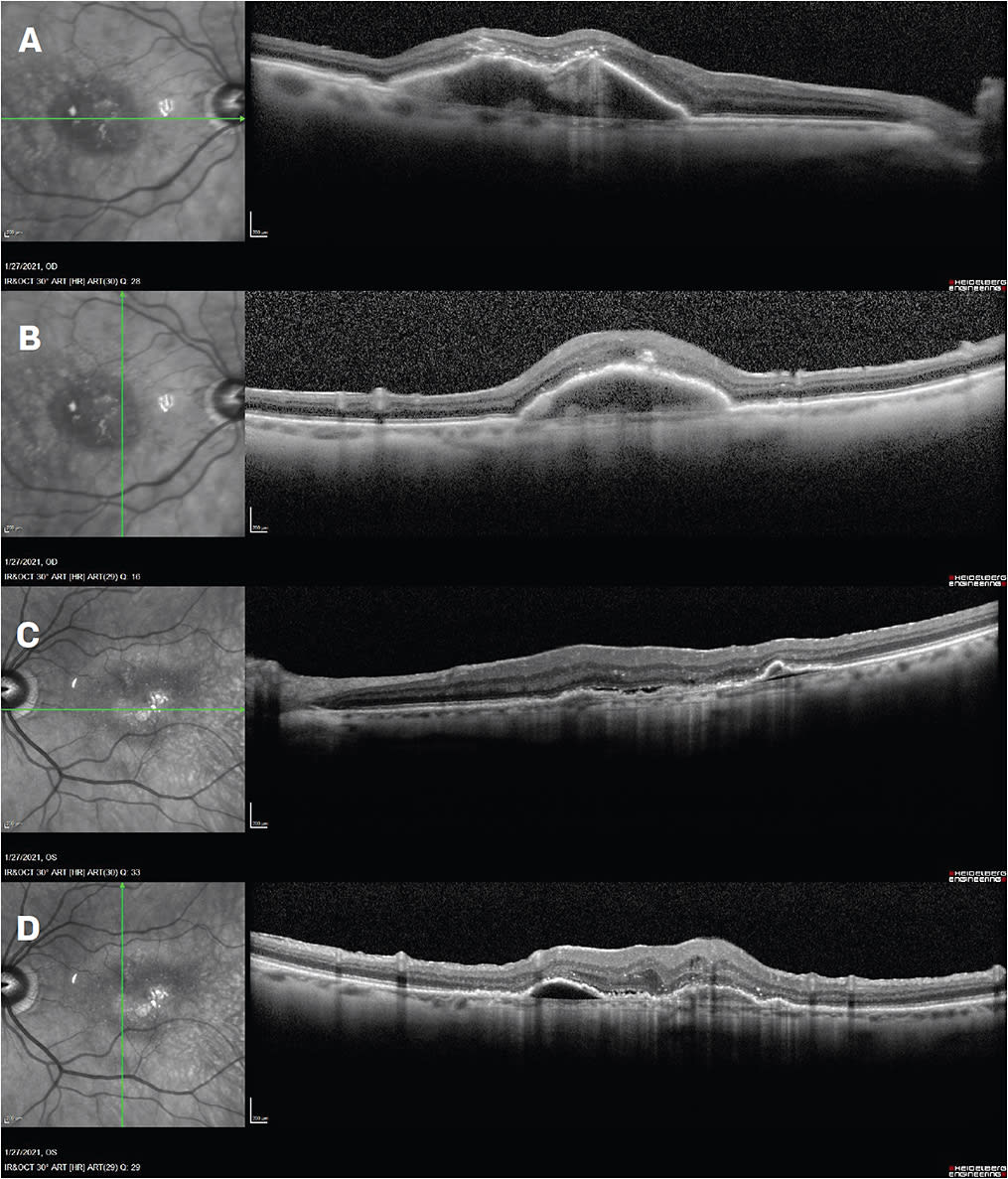 Figure 2. Same patient as Figure 1, now 1 month after aflibercept injection OD and brolucizumab injection OS. Acuity is 20/40- OD, with unchanged stable anatomy (A and B). Horizontal and vertical OCT OS show reduction of PED, resolved SRF, and organization of the retina, with visual acuity at 20/50, a marked improvement from 20/100 1 month prior (C and D).