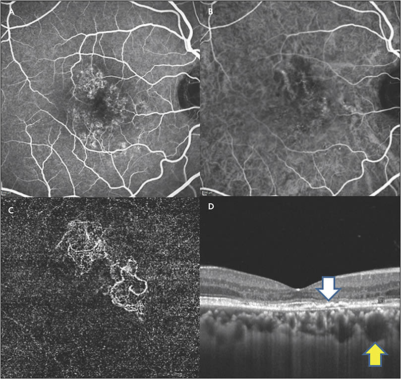 Figure 1. Fluorescein angiography shows submacular occult leakage (A). Indocyanine green imaging shows nonspecific submacular choroidal neovascular membrane without indocyanine green hyperpermeability (B). Optical coherence tomography angiography shows prominent arteriolarized choroidal neovascularization (C). Optical coherence tomography shows pachychoroid with pachy vessels (yellow arrow) and double-layer sign (white arrow) (D).