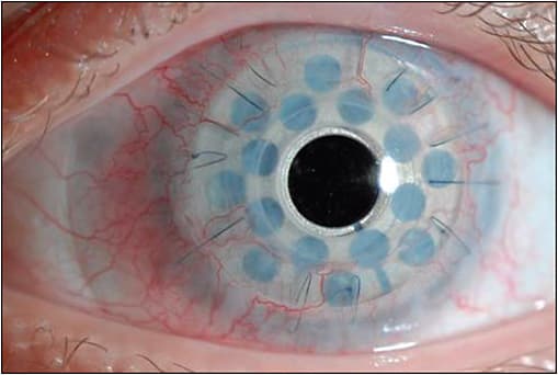Figure 1. Boston keratoprosthesis type 1 implant in a patient with aniridia.
IMAGE COURTESY OF KATHRYN COLBY, MD, PHD, LOUIS BLOCK PROFESSOR AND CHAIR, DEPARTMENT OF OPHTHALMOLOGY AND VISUAL SCIENCE, THE UNIVERSITY OF CHICAGO SCHOOL OF MEDICINE AND BIOLOGICAL SCIENCES.