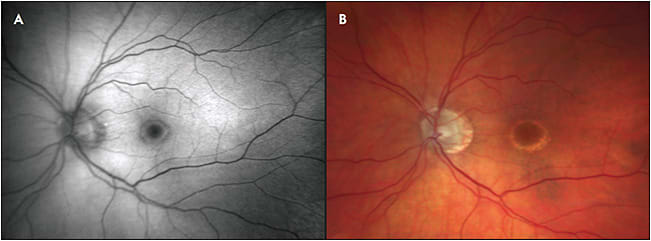 Figure 1. Fundus autofluorescence (A) and color fundus (B) photos of a patient with hydroxychloroquine toxicity.