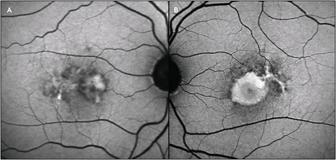 Figure 5. Adult foveomacular vitelliform dystrophy toxicity (A, right eye; B, left eye). Increased autofluorescence is seen corresponding to the vitelliform deposits, along with mottled increased and decreased autofluorescence, which is typical of pattern dystrophies.
