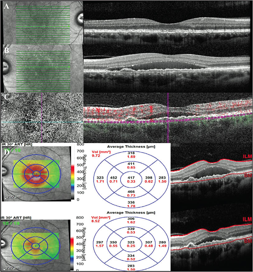 Figure 4. Patient with history of intermediate AMD of the right eye and intermediate AMD and chronic central serous chorioretinopathy (CSCR) of the left eye. OCT of the right eye demonstrates drusenoid pigment epithelial detachments (PEDs) overlying enlarged choroidal vessels (A). OCT of the left eye demonstrates a confluent row of PEDs, forming a “double-layer” sign. The inner hyperreflective band is the retinal pigment epithelium (RPE), and the outer hyperreflective layer is Bruch’s membrane. Note the significant subretinal fluid (SRF) out of proportion to what we would expect from exudative AMD (B). OCT-A demonstrates a Type 1 neovascularization that is partially visualized on the choriocapillaris slab (left panel). The cross-sectional OCT with flow overlay demonstrates subtle flow signals below the RPE (right panel) (C). An OCT change analysis demonstrates spontaneous reduction in the degree of SRF over the course of 1 month (D).