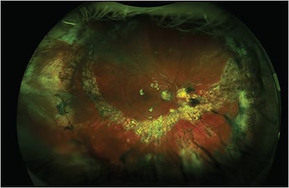 Figure 2. Fundus photograph of the right eye in the same patient 1 year after repeat retinal detachment repair with a series of 9 intravitreal methotrexate injections. The retina is flat under oil. A persistent superior subretinal band remains, but there is no retinal traction. A large inferior retinectomy with laser is noted.