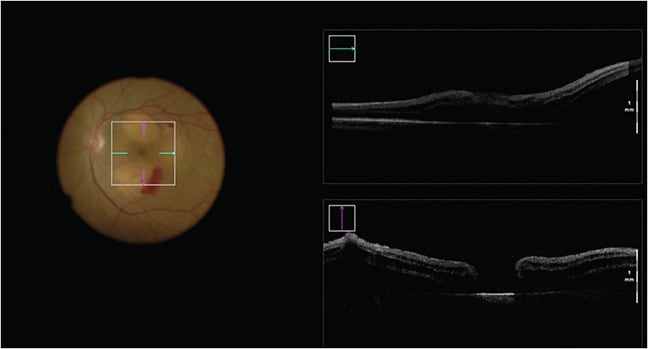 Figure 2. Recurrent macular hole in a 63-year-old female who had previous failed repeat vitrectomy with inner limiting membrane peel and free inner limiting membrane flap. Macular hole closure was obtained with 38-gauge administration of balanced salt solution subretinally, confirmed with intraoperative optical coherence tomography. Image courtesy of Jessica Cao, MD, and Sumit Sharma, MD, Cole Eye Institute, Cleveland Clinic.
