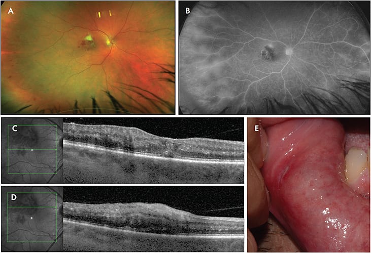 Figure 2. A patient presented with acute loss of vision in the right eye and was found to have unilateral nongranulomatous panuveitis characterized by fine keratic precipitates, iritis, vitritis, macular infiltrates (A), and diffuse vascular leakage on fluorescein angiography (B). Optical coherence tomography revealed subretinal fluid and retinal thickening in the macula (C, D). Examination of the patient’s oral cavity revealed numerous painful aphthous ulcers (E).