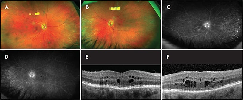 Figure 1. A 67-year-old pseudophakic female presented for evaluation of blurry vision in both eyes. She was found to have bilateral nongranulomatous panuveitis. Her medical history was significant for pulmonary nodules and mediastinal lymphadenopathy, which was being worked up by her pulmonologist. Ultrawidefield fundus images (Optos) revealed peripheral chorioretinal pigmentary changes without evidence of active vasculitis (A, B). Fluorescein angiography revealed diffuse leakage consistent with active inflammation (C, D) and optical coherence tomography revealed cystoid macular edema in both eyes (E, F). Infectious workup (syphilis and tuberculosis) was negative. She was subsequently treated with intravitreal triamcinolone acetonide with significant improvement. Her pulmonologist ultimately performed a transbronchial biopsy, which revealed noncaseating granulomas consistent with sarcoidosis.