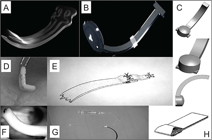 Figure 5. Types of macular buckles (MB). Ando plombe MB (Ondeko Corp), solid silicone with titanium wire (A); AJL MB, polymethylmethacrylate, PMMA (B); Adjustable MB, solid silicone (C); L-shaped MB, silicone sponge with titanium wire (D); donor sclera (E); L-shaped MB, silicone sponge with stainless steel wire (F); suprachoroidal catheter with hyaluronic acid (G); T-shaped MB, solid silicone (H).