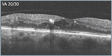 B: Status post treatment with initial therapy