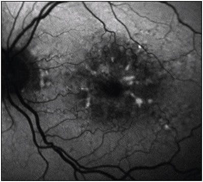 Figure 3. Age-related macular degeneration. Note increased autofluorescence, which correspond to macular drusen, and decreased autofluorescence, corresponding to pigment clumping.