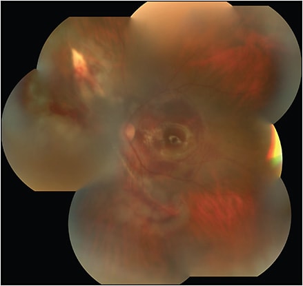 Figure 1. Ocular perforation with vitreous hemorrhage from retrobulbar block. Note the bare sclera visible superonasally with a linear scar extending nasally and inferiorly to the optic nerve.