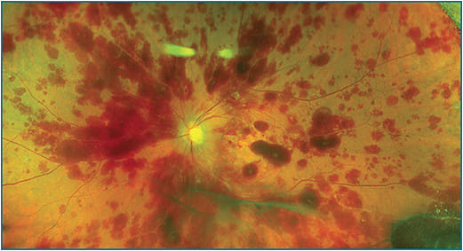 Fundus photo of the left eye of patient, showing diffuse pre-retinal and intraretinal hemorrhage 13 days after intravitreal stem cell injection. Collections of cells can be seen in the vitreous cavity below the optic nerve and in the lower right-hand corner. This retina detached 3 weeks later.
Photo courtesy of Thomas Albini, MD