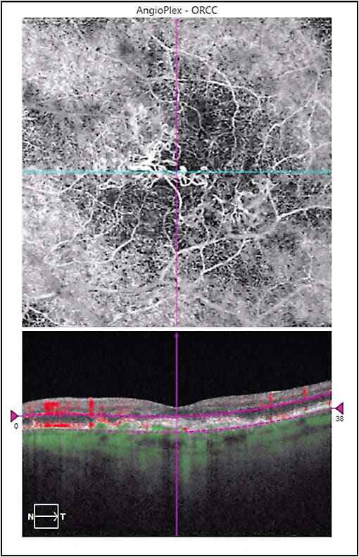 Figure 1. Type 2 choroidal neovascularization, left eye, in wet age-related macular degeneration. Top, optical coherence tomography (OCT) angiography image at the level of the outer retina–choriocapillaris. Subfoveal choroidal neovascularization, coursing into the superonasal and inferotemporal macula, is seen under the retinal vessels. Bottom, OCT image with flow indicators.